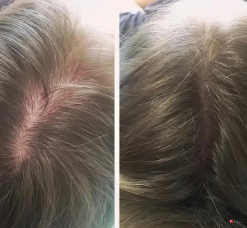 ОТВАР ДЛЯ ВОЛОС ПРОТИВ ВЫРАДЕНИЯ ОТ ПЕРХОТИ И ДЛЯ РОСТА