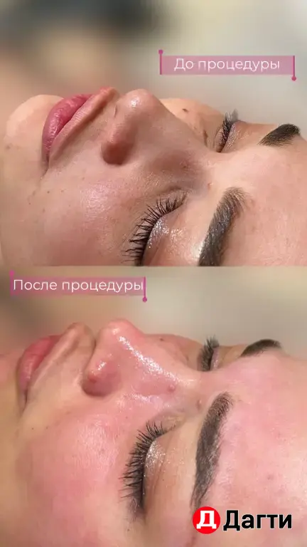 Модель на чистку лица и жидкий лазер