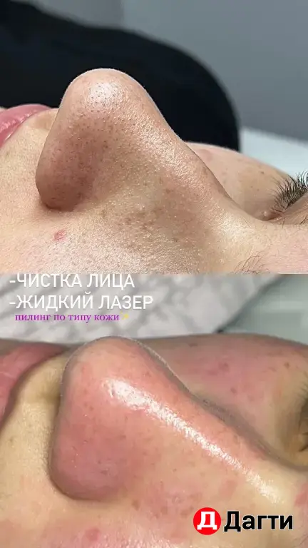 Модель на чистку лица и жидкий лазер