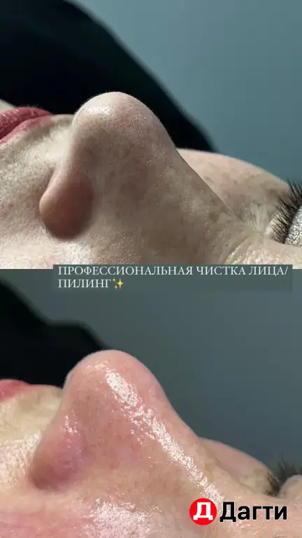 Модель на чистку лица и жидкий лазер