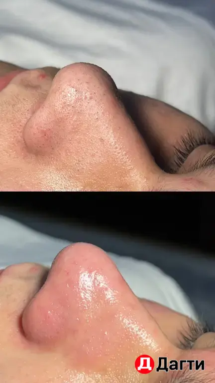 Модель на чистку лица и жидкий лазер