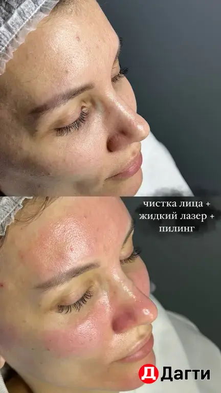 Модель на чистку лица и жидкий лазер