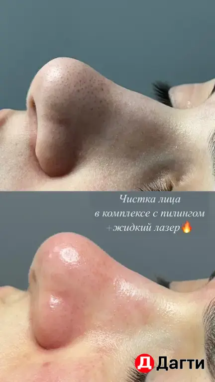 Модель на чистку лица и жидкий лазер