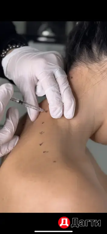 Ботекс . Ботулотоксин в трапециевидную мышцу .